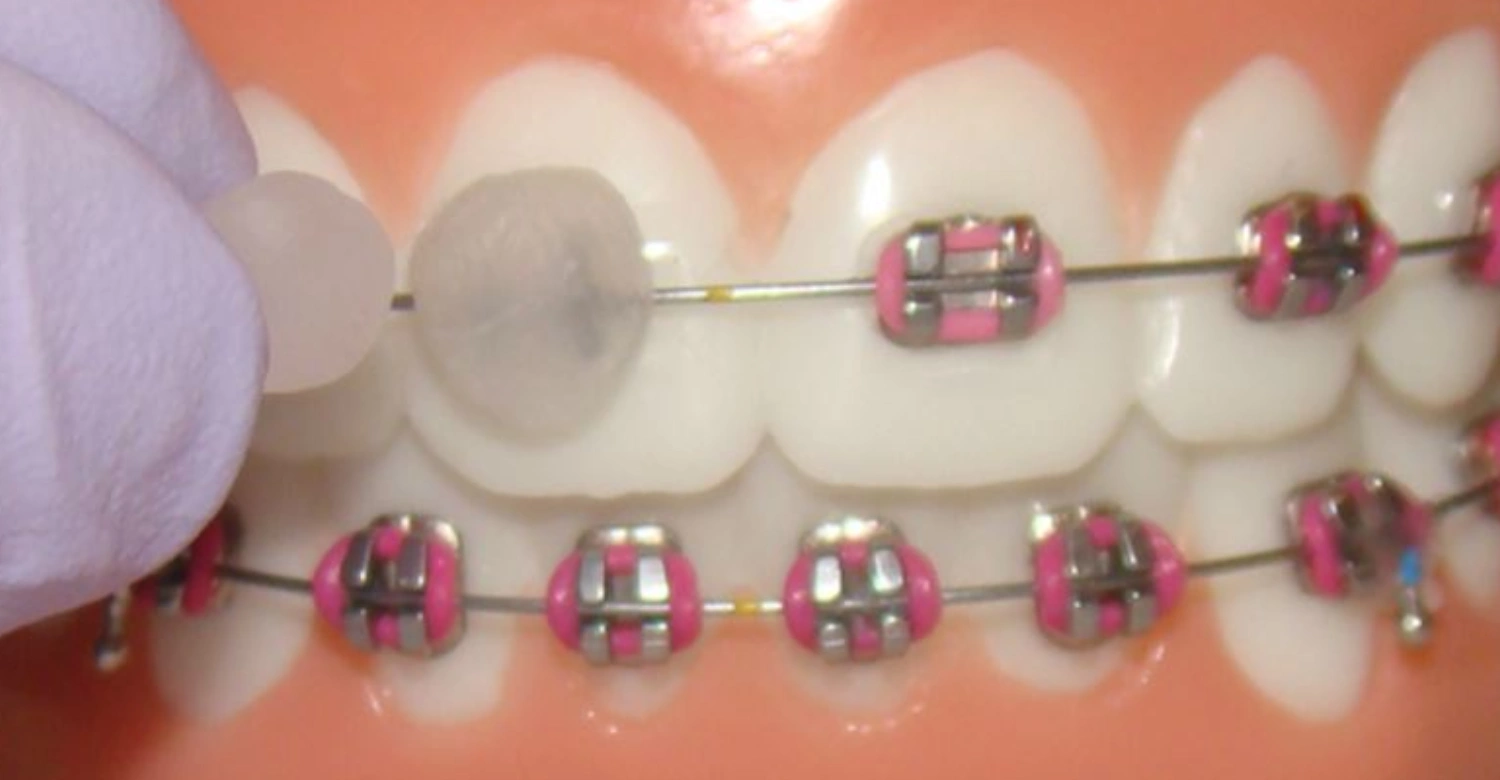 What happens if you swallow orthodontic wax